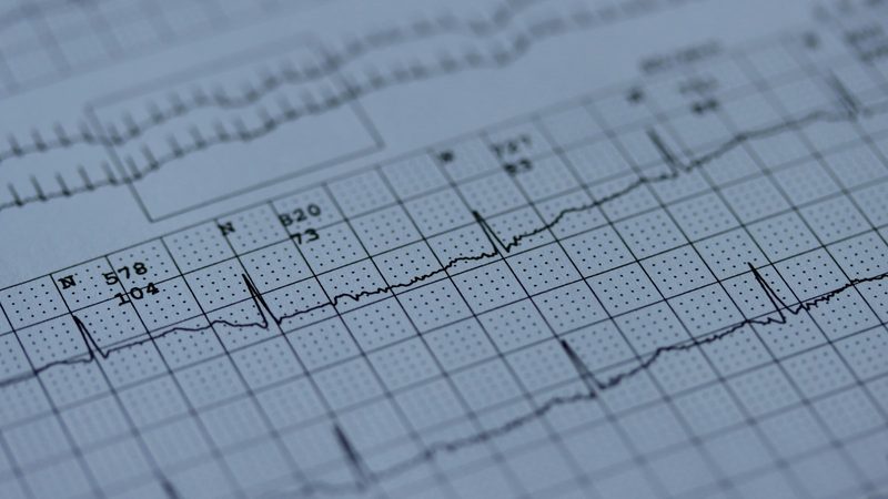 An EKG printout: the heart's rhythm traced across grid paper